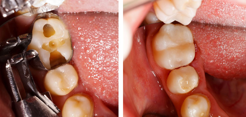 composite fillings