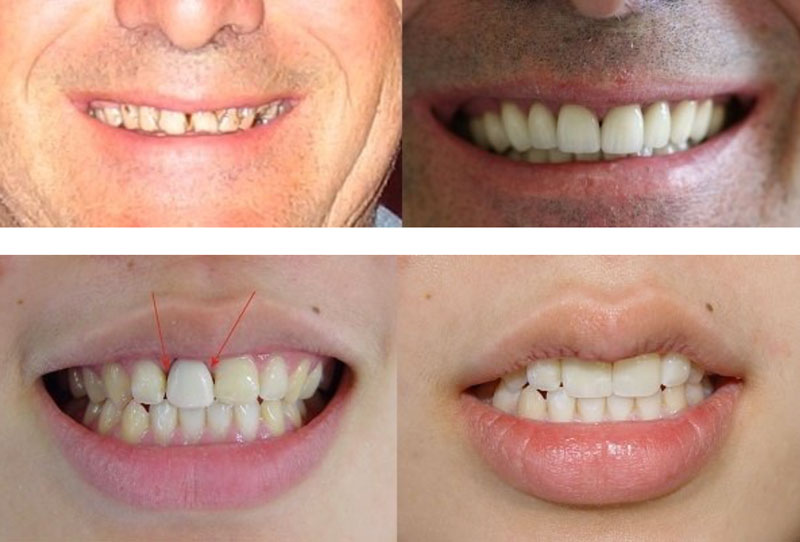 tooth veneer tooth veneer