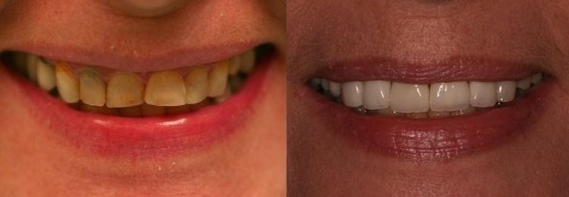 tooth veneer