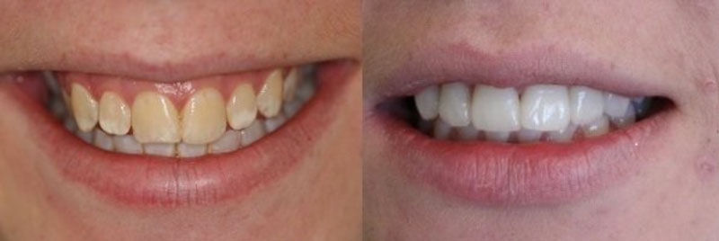 tooth veneers